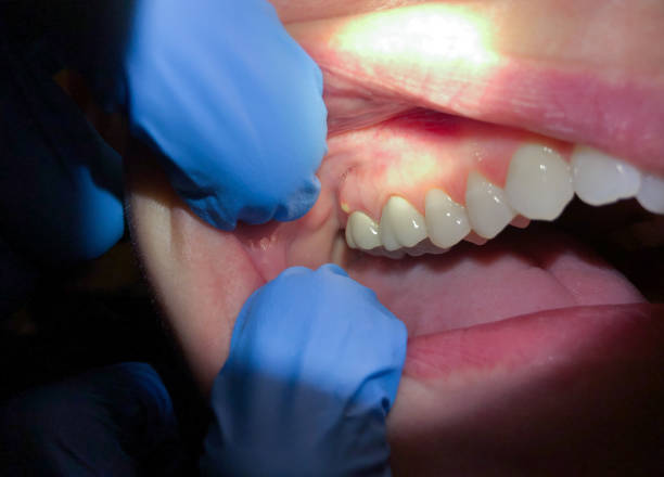 Best Emergency Dental Care for Sports Injuries in Hilltop, SC